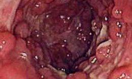 Viêm dạ dày - ruột do nhiễm khuẩn và bệnh Crohn